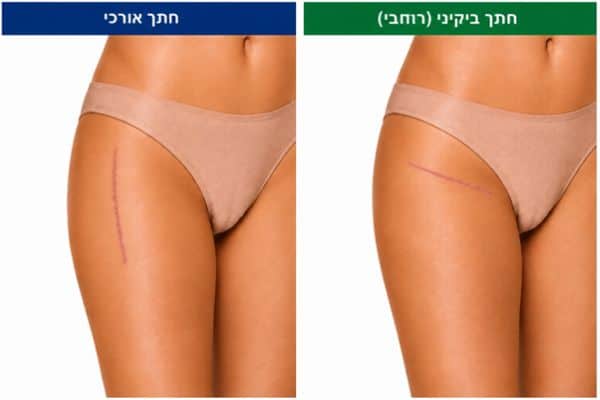 הצלקת הניתוחית בגישה קדמית להחלפת מפרק ירך